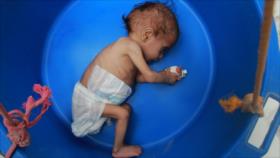 ONG: Crisis alimentaria, “sentencia de muerte” para niños yemeníes