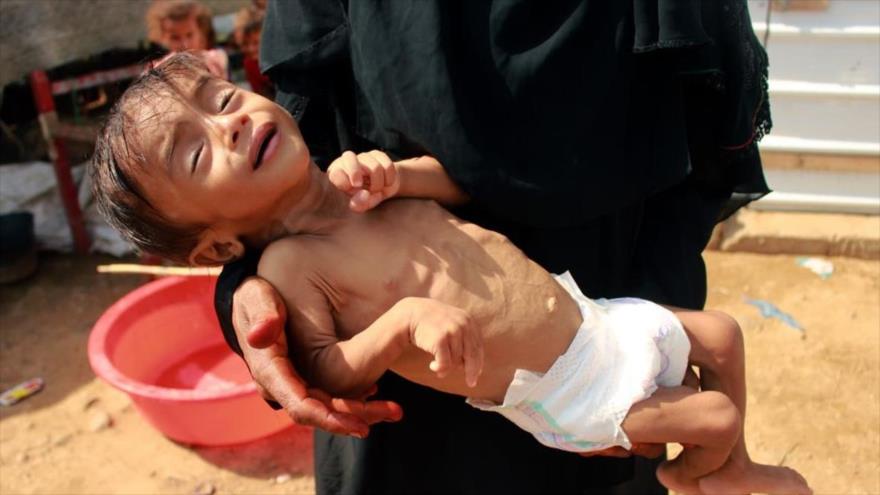 Niño yemení con la desnutrición aguda que no puede llegar a un hospital para recibir tratamiento en el norte de Yemen, 3 de septiembre de 2020. (Foto: AFP)