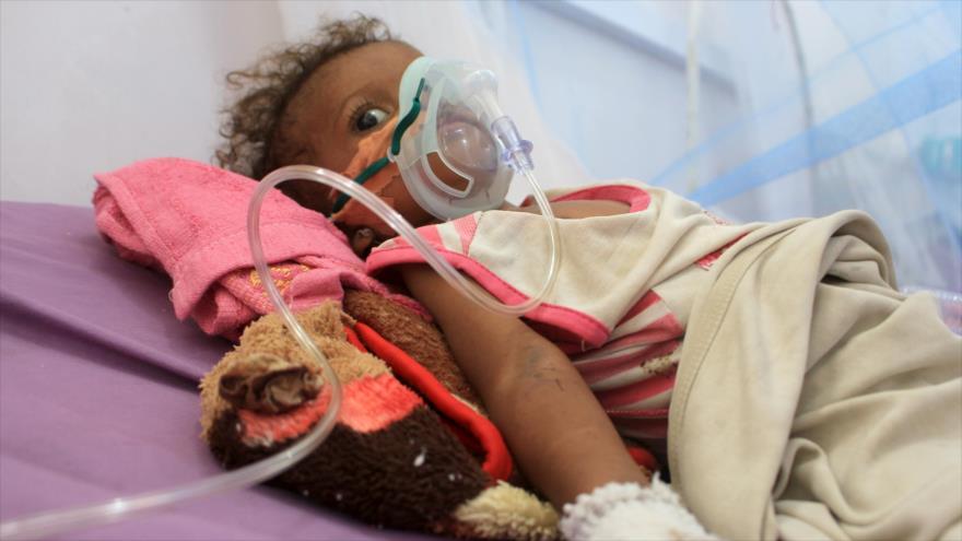 Un niño yemení que sufre de desnutrición en un hospital de Hajjah, en el norte del país árabe, 22 de noviembre de 2020. (Foto: AFP)