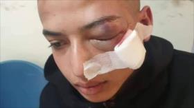 Menor palestino herido en un ojo por disparo de fuerzas israelíes