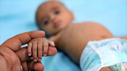 ONU: 400 000 niños yemeníes en riesgo de morir por malnutrición