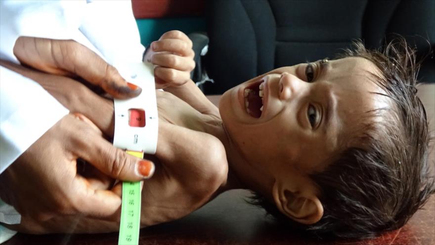 Niño yemení de dos años sufre desnutrición (pesa solo cinco kilogramos) en la ciudad occidental de Al Hodeida, 15 de febrero de 2021. (Foto: AFP)