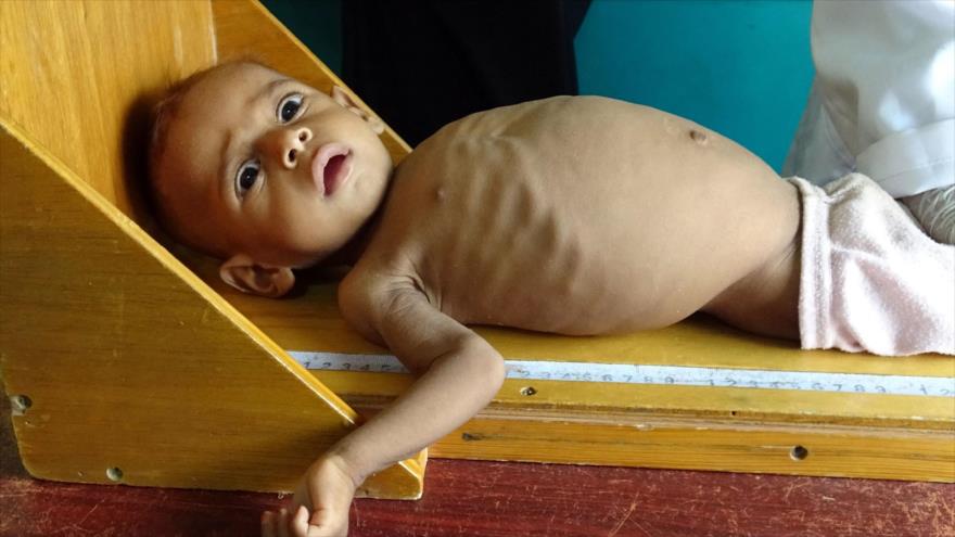 Un niño con desnutrición en un centro de salud en Yemen, 25 de septiembre de 2021. (Foto: AFP)