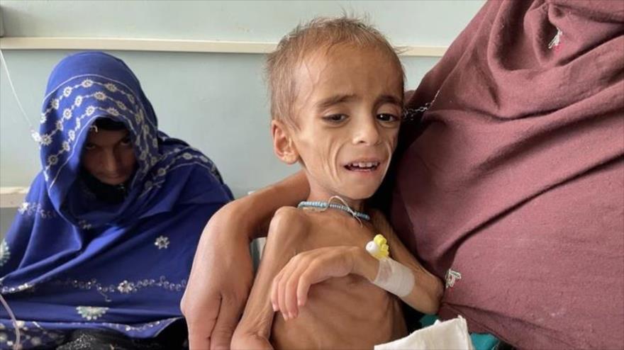 Un niño malnutrido en un hospital de Kandahar, en Afganistán.