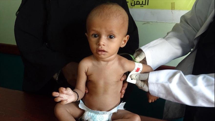Tres de cada cuatro niños sufren “desnutrición crónica” en Yemen