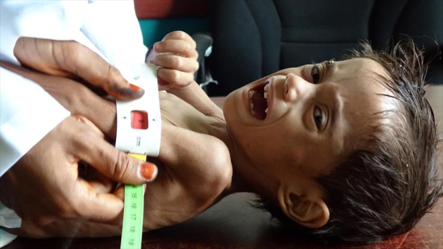 Niño yemení de dos años sufre desnutrición (pesa solo cinco kilogramos) en la ciudad occidental de Al Hodeida, 15 de febrero de 2021. (Foto: AFP)
