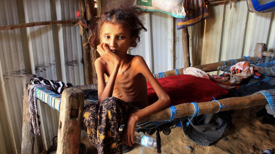 Un niño desnutrido yemení. (Foto: AFP) 
