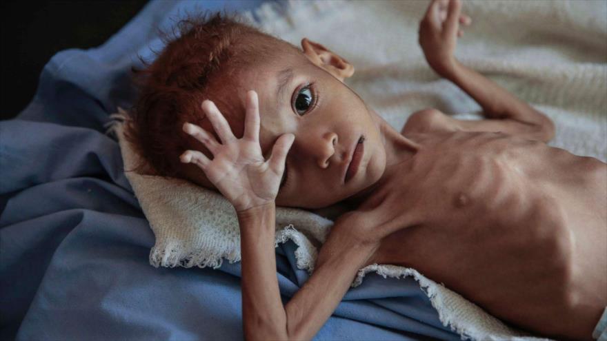 Un niño yemení que sufre de la desnutrición aguda .