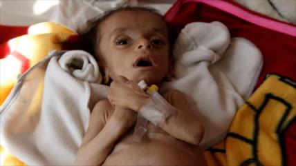 Yemen: 3000 niños con cáncer, a punto de muerte por bloqueo saudí