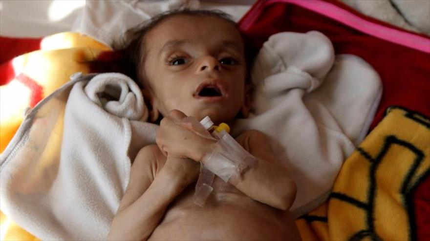 Un niño recibe atención médica en Saná, capital yemení. (Foto: Reuters)