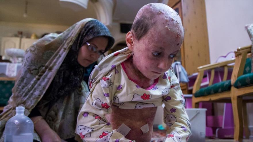 Una madre iraní atiende a su hija enferma con epidermólisis ampollar (EB, por sus siglas en inglés), conocida como “Piel de Mariposa”.
