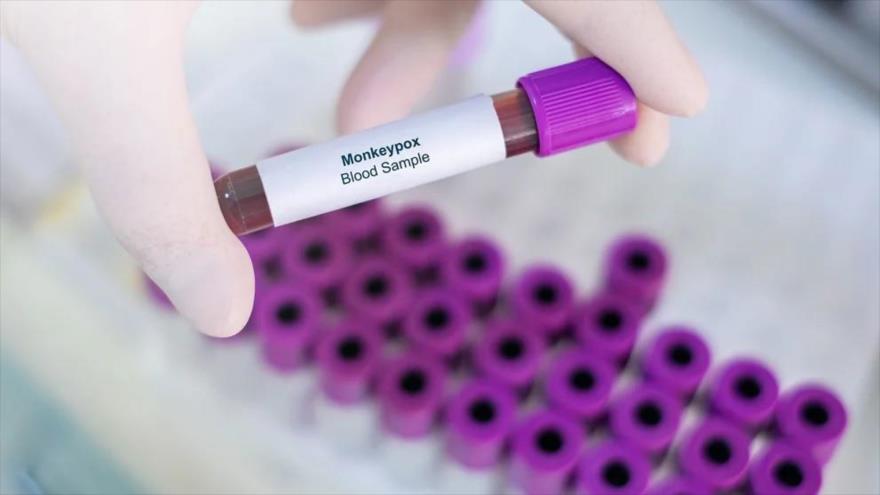 Identificaron en el Reino Unido una nueva variante genética de viruela de mono.