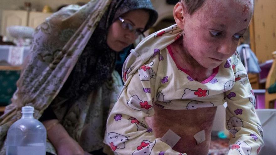 Una madre iraní atiende a su hija enferma con epidermólisis ampollar (EB, por sus siglas en inglés), conocida como “Piel de Mariposa”.