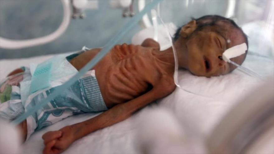 Un bebé yemení que sufre malnutrición aguda se encuentra en una incubadora en un hospital en Yemen. (Foto: AFP)
