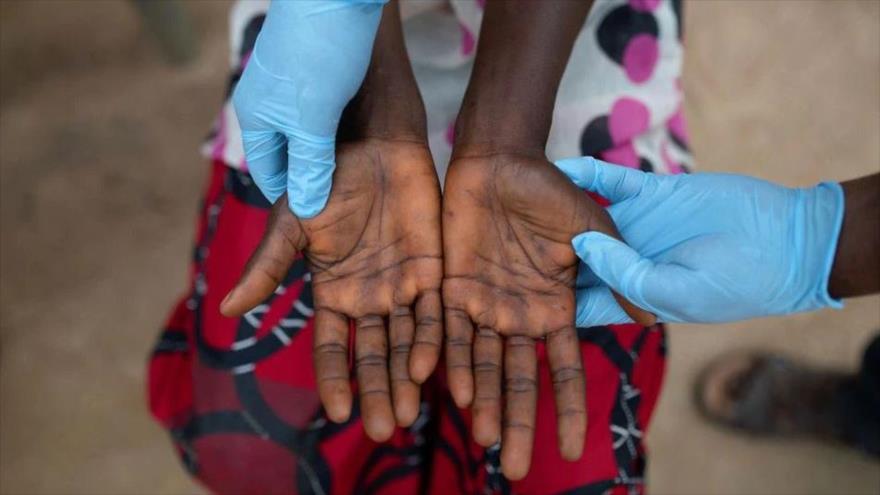 Un médico examina las manos de un paciente con viruela del mono, 2 de octubre de 2022. (Foto: Reuters)
