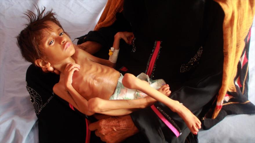 Una mujer sostiene a un niño desnutrido en un centro de tratamiento en la provincia norteña de Hajja, Yemen, 5 de julio de 2020. (Foto: Getty Images)