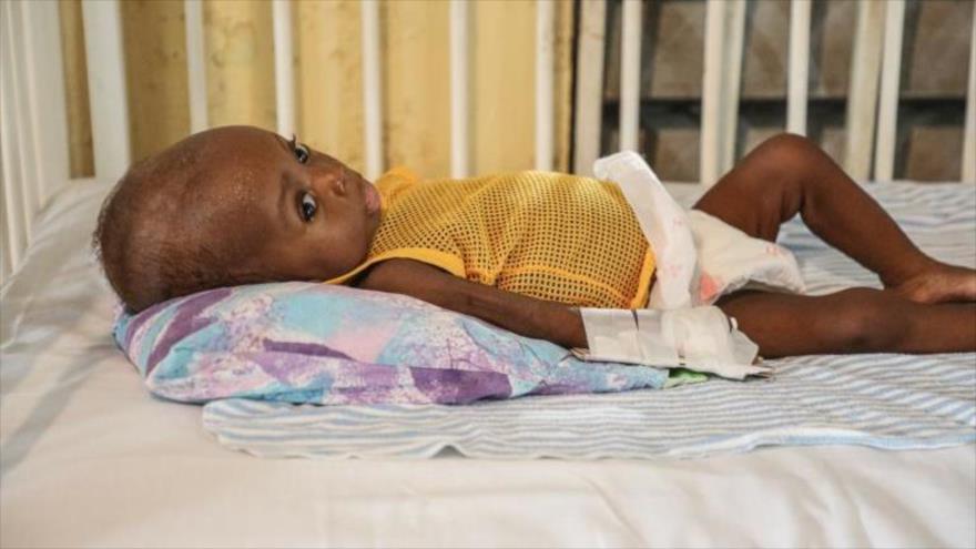 Un infante con evidentes signos de desnutrición logra ser atendido en un hospital de Puerto Príncipe, la capital haitiana. Foto: Unicef