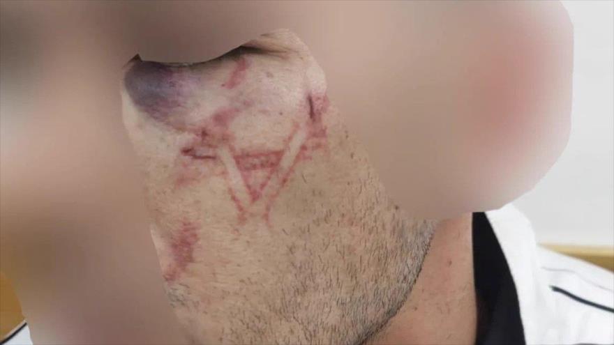 La cara de un palestino que las fuerzas israelíes la marcaron una “estrella de David”.