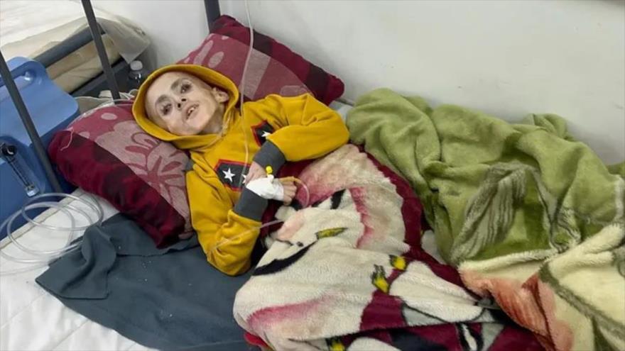 El niño palestino, que padecía parálisis cerebral y murió más tarde debido a la desnutrición, yace en una cama en hospital Al-Awda, en Gaza. (Foto: Reuters)