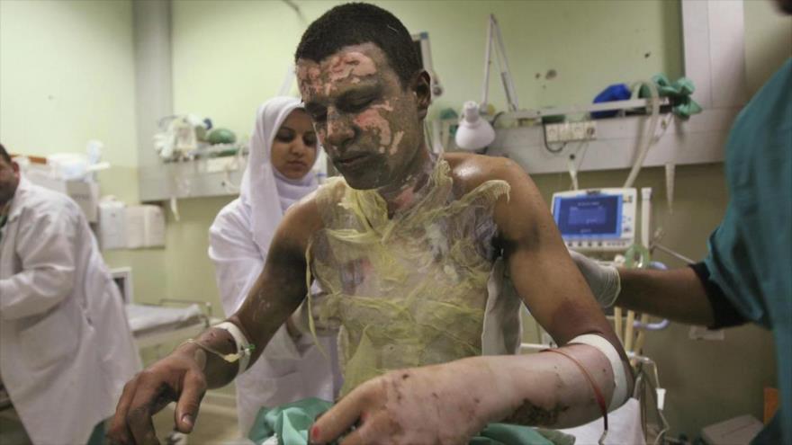 Un palestino siendo tratado por quemaduras en el Hospital Al-Naser en KJan Yunis, en el sur de la Franja de Gaza. (Foto: AP)