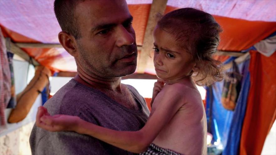 Una niña gazatí que sufre desnutrición, desplazada del suburbio oriental de Shejaiya, en la ciudad de Gaza, 4 de junio de 2024. (Foto: AFP)