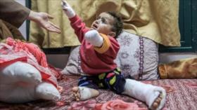 “Amputaciones pediátricas en Gaza baten record en la historia”