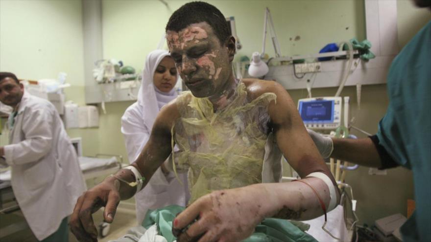 Un palestino que recibe tratamiento por quemaduras en el hospital Al-Naser de Jan Yunis, en el sur de Gaza, tras un ataque aéreo de Israel. (Foto: AP)