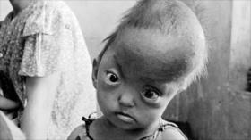 Niños vietnamitas con defectos debido al Agente Naranja | Fotos que sacuden al mundo