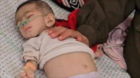 Bebé número 54 muere por inanición en Gaza bajo el asedio de Israel