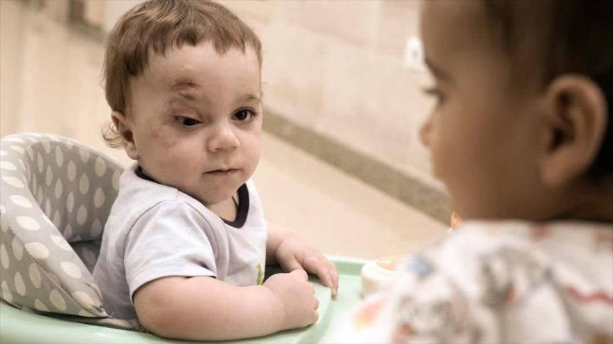 Mostafa Qadoura, bebé palestino de diez meses, pierde un ojo en los ataques indiscriminados de Israel contra la Franja de Gaza. (Foto: Associated Press)