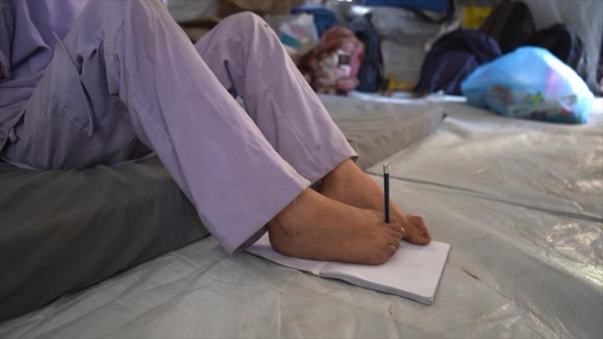 Miles de niños sufren amputaciones tras ataques de Israel en Gaza