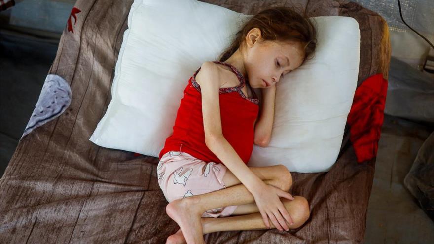 Una niña palestina, desnutrida, recibe tratamiento en el hospital de campaña del Cuerpo Médico Internacional en Deir Al-Balah, al sur de la Franja de Gaza. (Foto: Reuters)