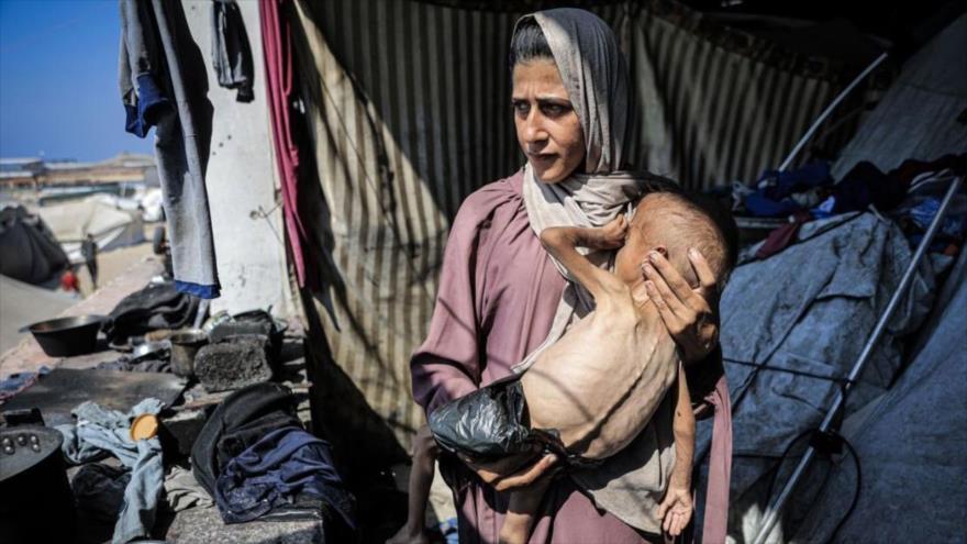 Un año gazatí se enfrenta a una desnutrición potencialmente mortal mientras la situación humanitaria empeora en Gaza. (Foto: Anadolu)
