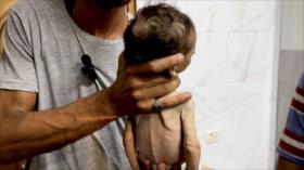 El hambre impuesto por Israel mata a bebé palestino de 6 meses