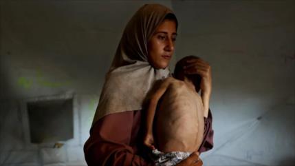La crisis alimentaria en Gaza deteriora la salud de la población