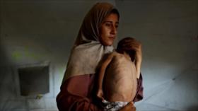 La crisis alimentaria en Gaza deteriora la salud de la población