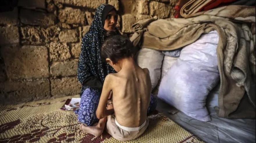 Una mujer consuela a su hija de 6 años, que sufre malnutrición, en un refugio en el centro de la ciudad de Gaza, 11 de mayo de 2025. (Foto: AP)