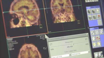 Radiofármaco iraní detecta el Alzheimer 20 años antes de su aparición