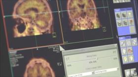 Radiofármaco iraní detecta el Alzheimer 20 años antes de su aparición