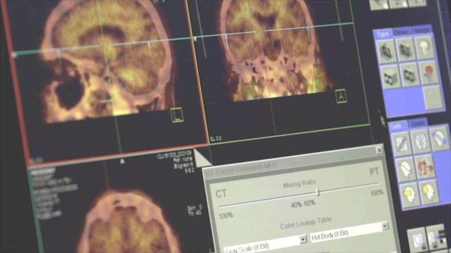 El escaneo cerebral para identificar y rastrear los signos de la enfermedad de Alzheimer.