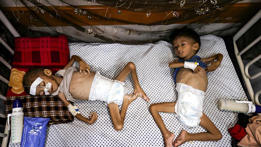 Dos niños palestinos recibieron tratamiento en un hospital debido a una desnutrición severa en Gaza, 3 de agosto de 2025. (Foto: Anadolu)