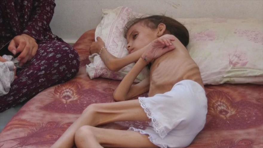 Una niña palestina sufre de malnutrición en Gaza.