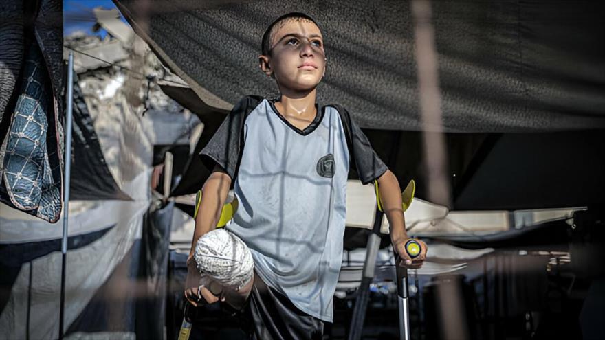 Muhammed Omar Selim Muslih, niño palestino de 10 años, resultó herido en un ataque israelí y sufrió una amputación debido a heridas de metralla, 8 de julio de 2025. (Foto: Anadolu)