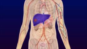 NanoStrike: Itrio-90 y la lucha contra el cáncer | Iran Tech