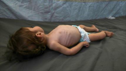 MSF: Niños en Gaza sufren efectos de por vida por desnutrición