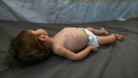 MSF: Niños en Gaza sufren efectos de por vida por desnutrición