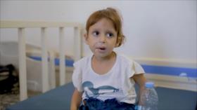 Gaza: niños sufren malnutrición en medio de la crisis alimentaria
